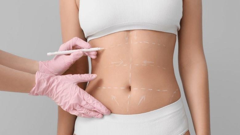 Tumescent Liposuction results