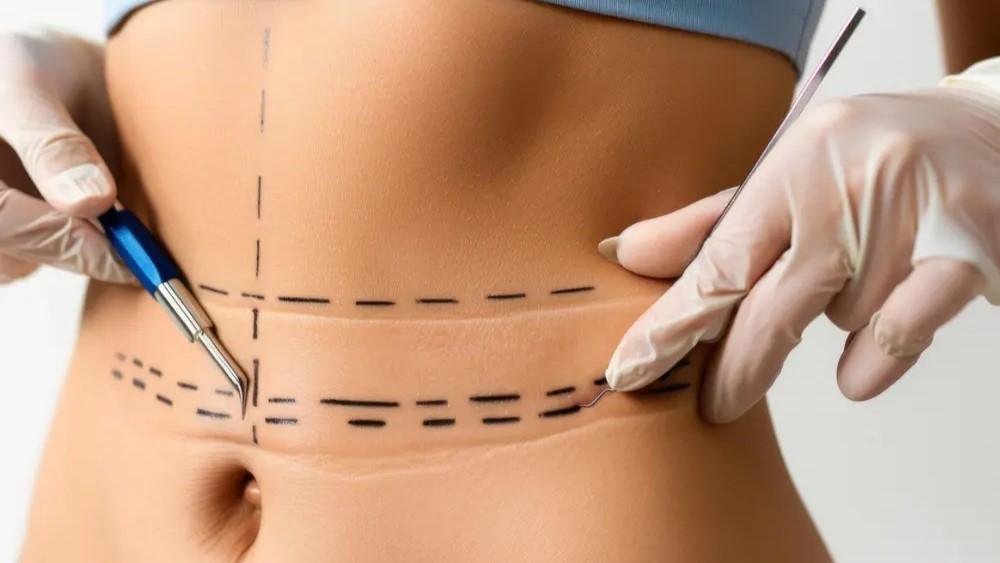 VASER liposuction
sculpt
body
stubborn
fat