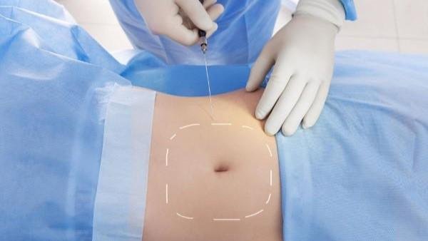 Tumescent Liposuction suction