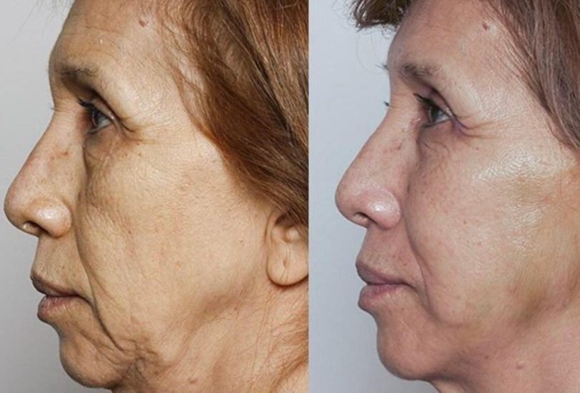 Anti-Aging Treatments