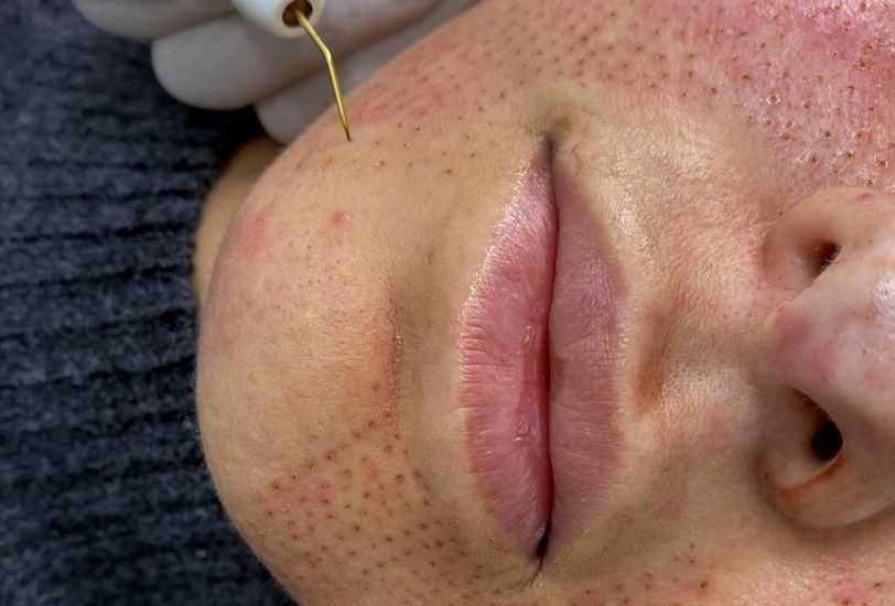 Injectable Treatments