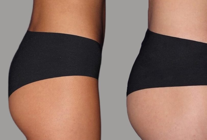 Non-Surgical Butt Lift