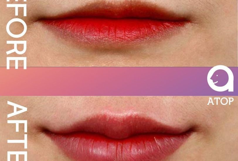 Lips Treatments