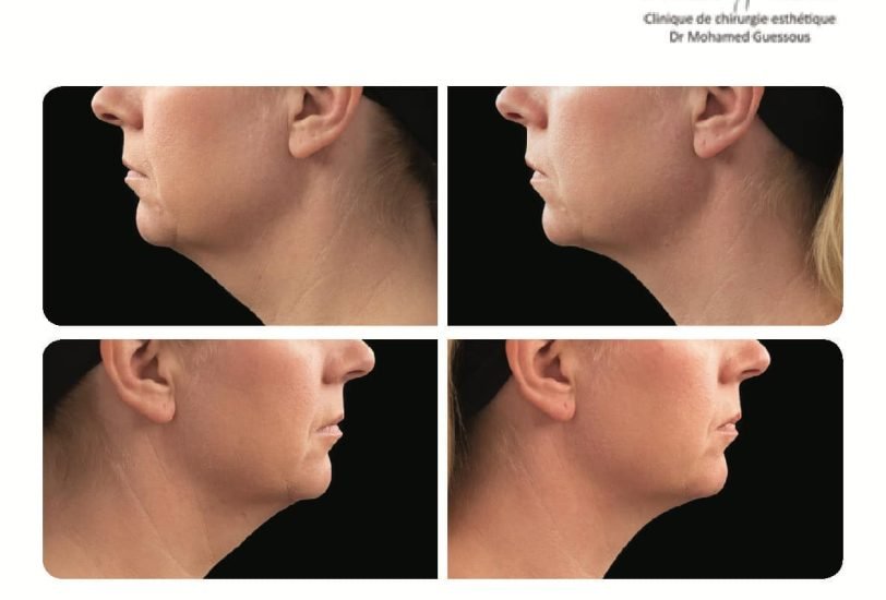 Double Chin & Jawline Contouring