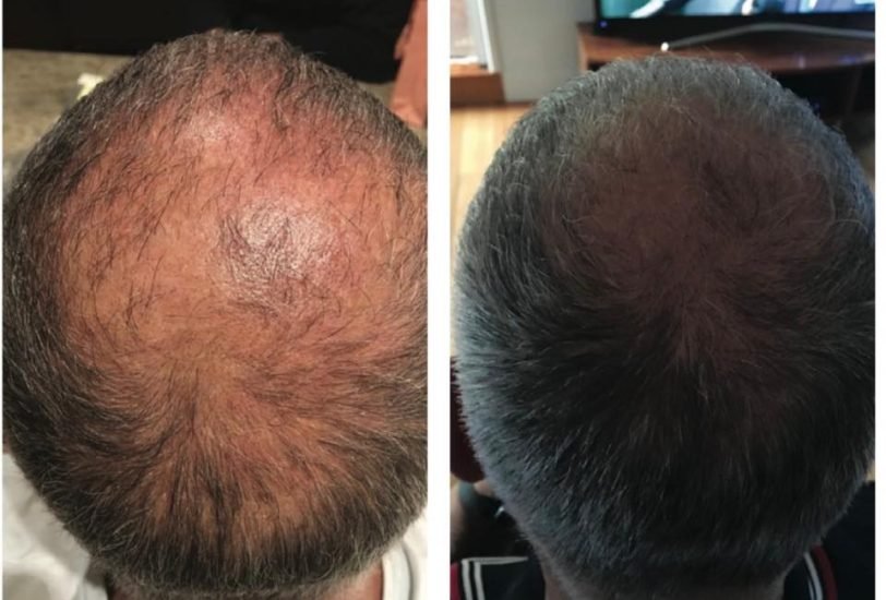 Skin Rejuvenation