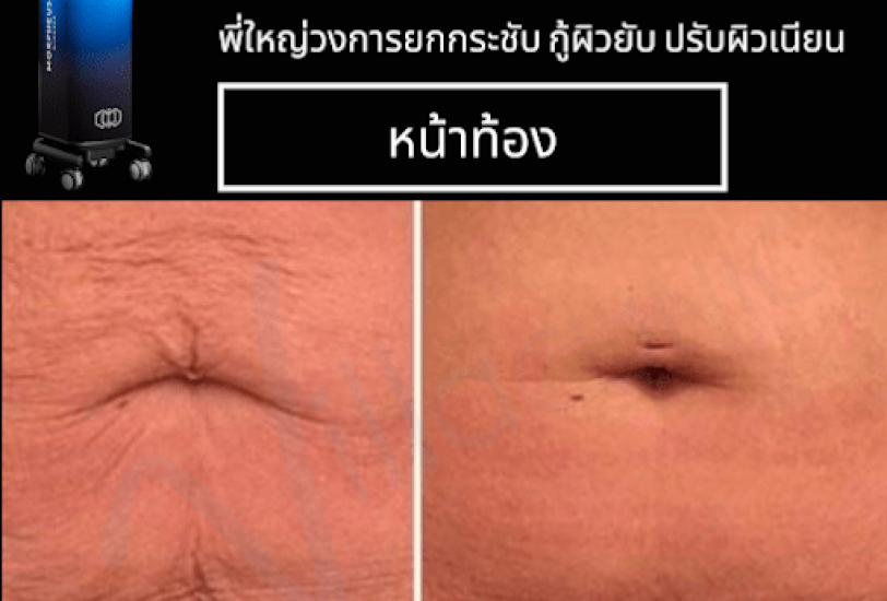 Body Contouring