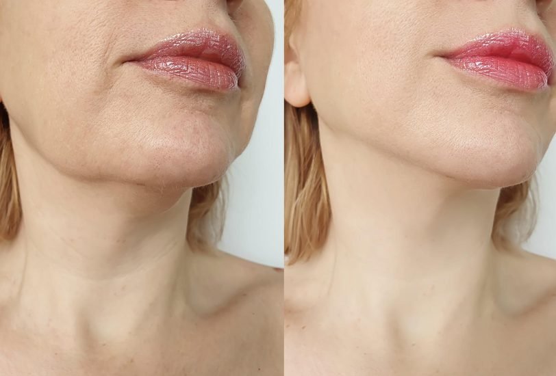 Skin Tightening