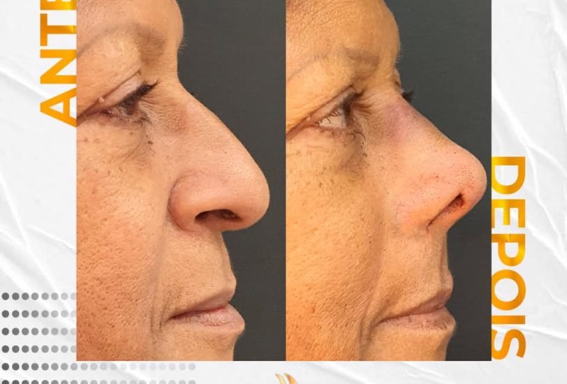 Facial Contouring & Lifting