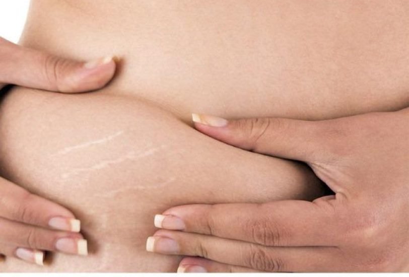 Fat Transfer