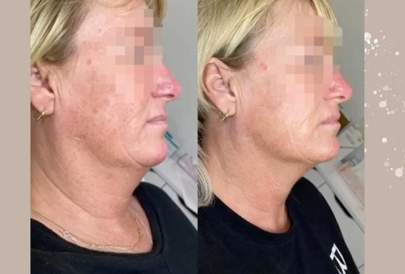 Acne & Scar Treatments