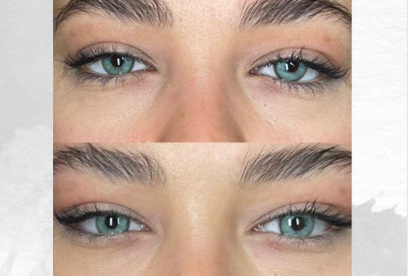 Eye Rejuvenation