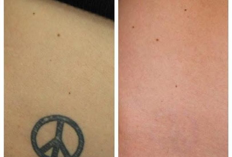 Body Contouring