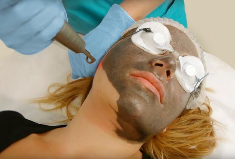 Laser Hair Removal