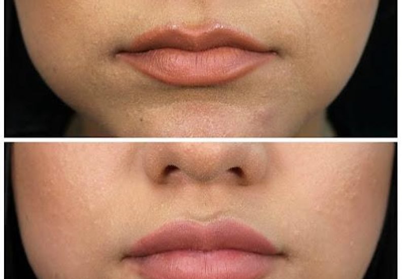 Injectable Treatments