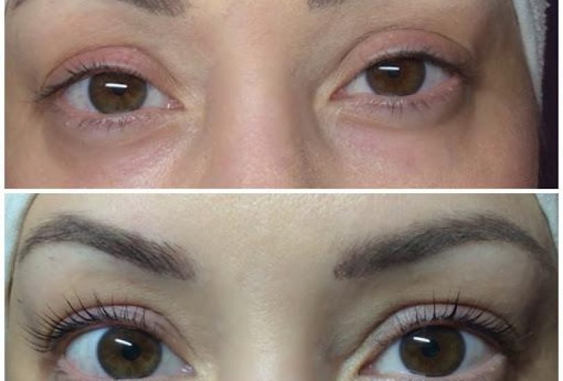 Laser & Light Therapies