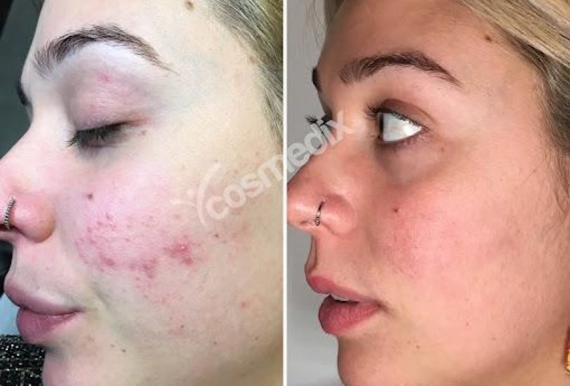 Acne & Scar Treatments