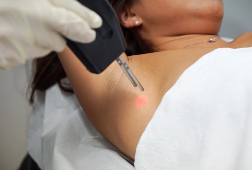 Laser Hair Removal