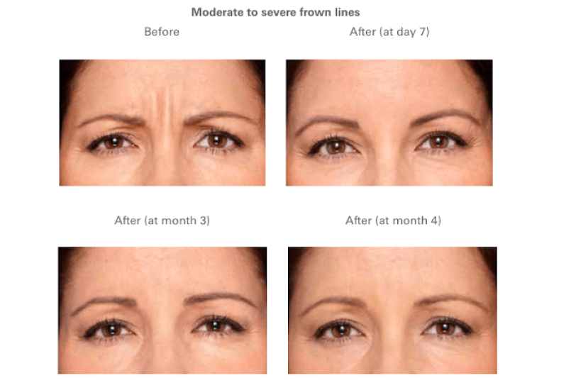 Eye Rejuvenation