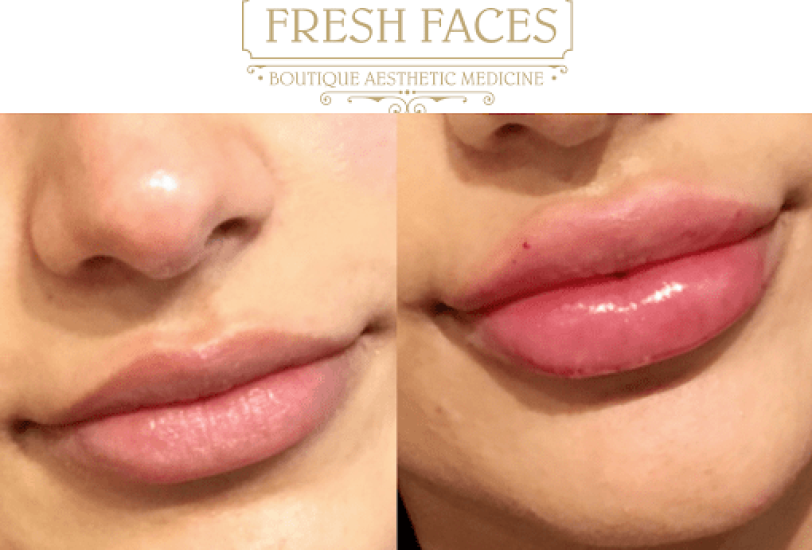 Lips Treatments