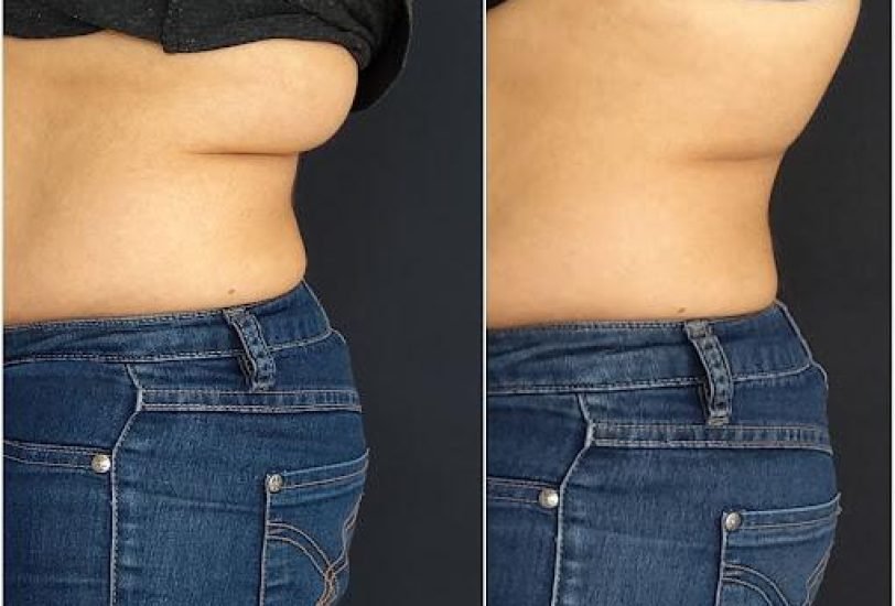 Body Contouring