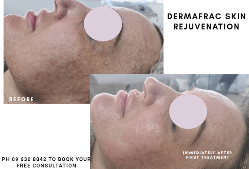 Acne & Scar Treatments