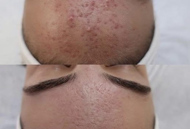 Acne & Scar Treatments