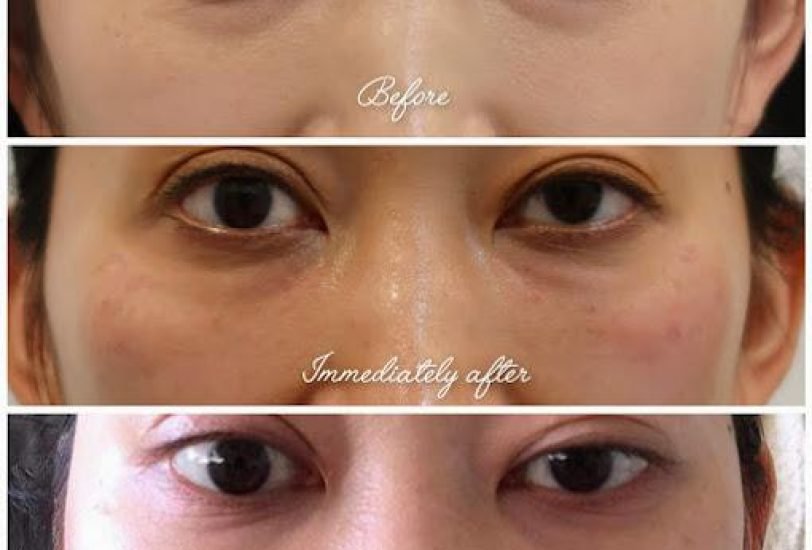 Eye Rejuvenation