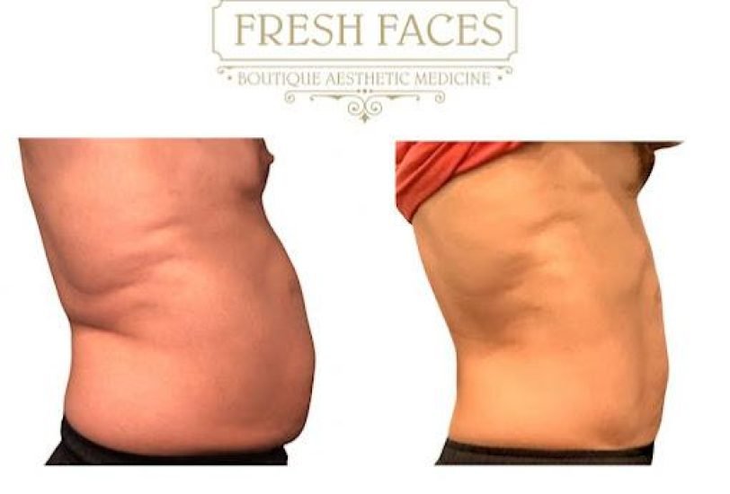 Body Contouring