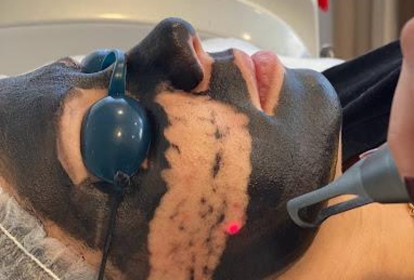 Pigmentation & Skin Tone Correction