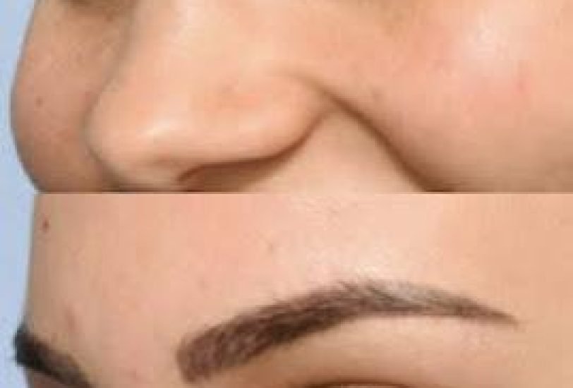 Facial Contouring & Lifting