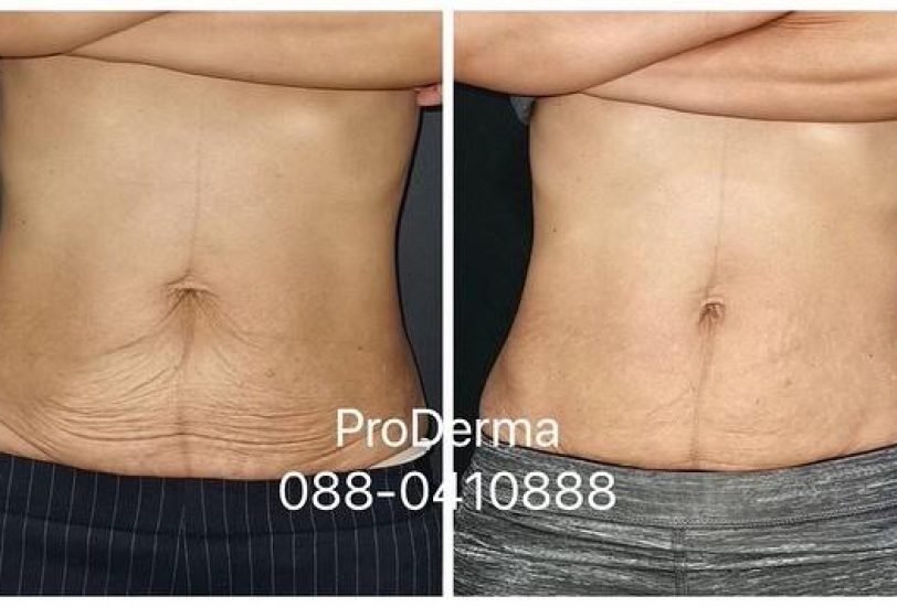 Body Contouring