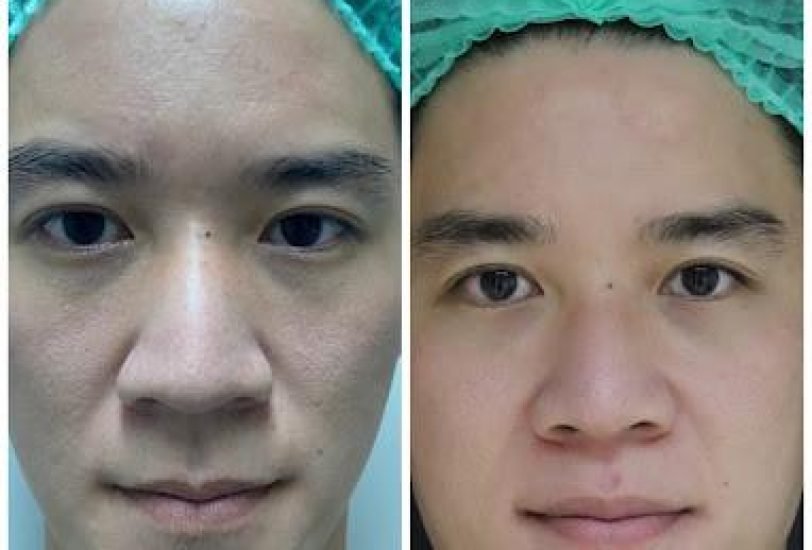 Facial Contouring & Lifting