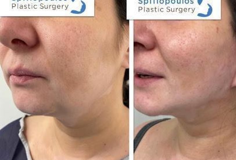Facial Contouring & Lifting