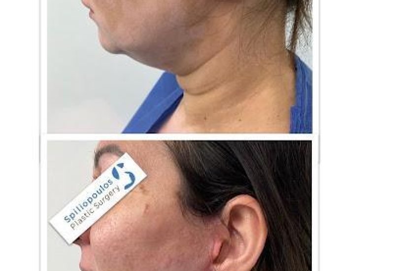 Double Chin & Jawline Contouring