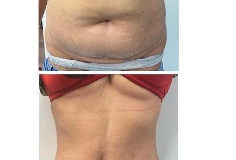 Fat Transfer