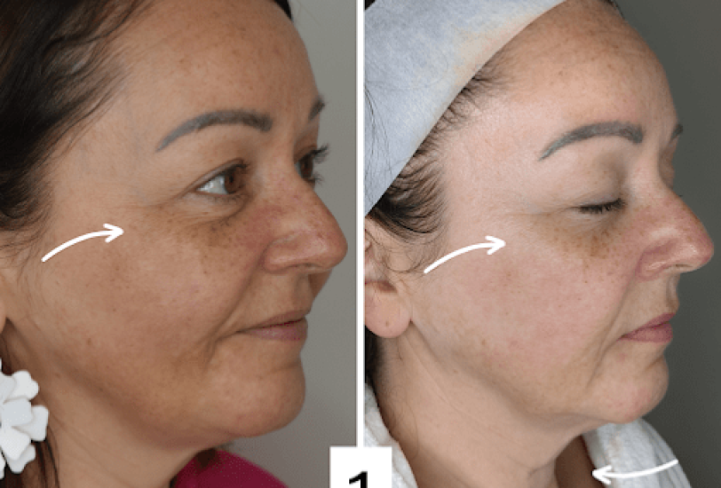 Anti-Aging Treatments