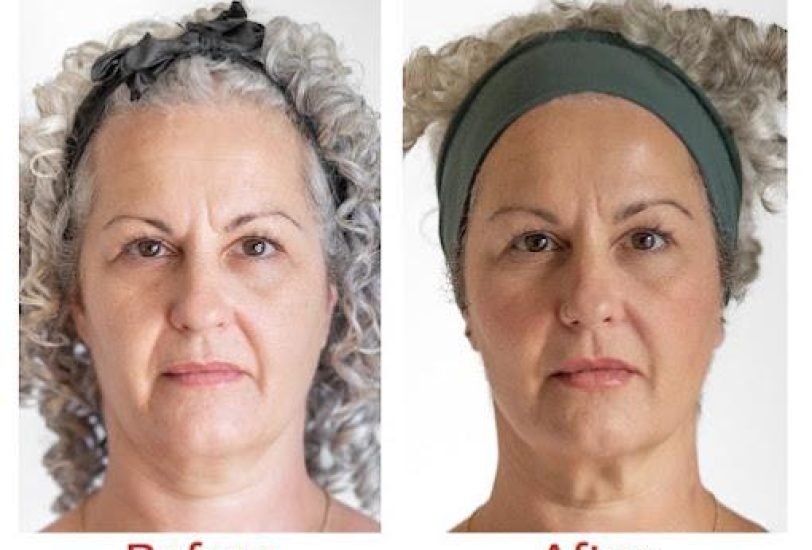 Fat Reduction Injections