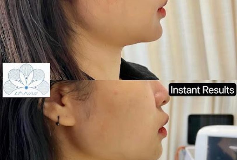 Acne & Scar Treatments
