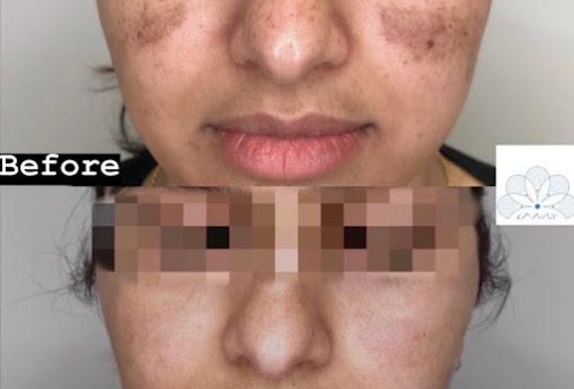 Scar Revision Treatments