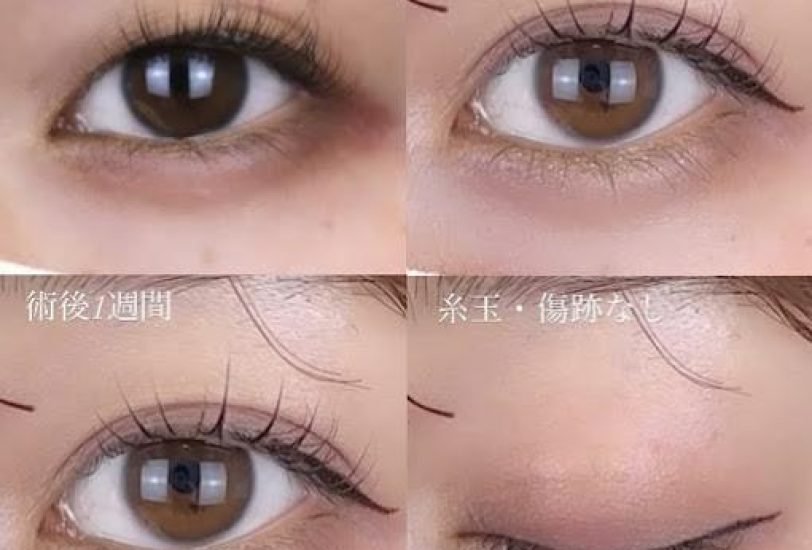 Eye Rejuvenation