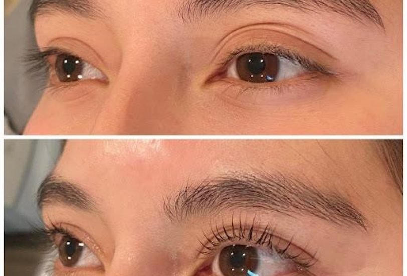 Eye Rejuvenation