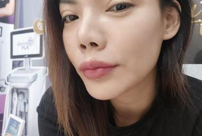 Skin Tightening