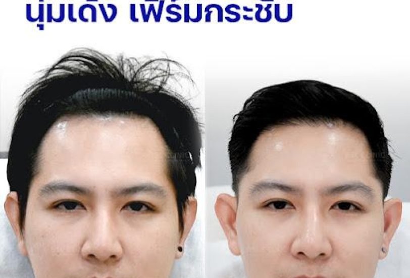 Facial Contouring & Lifting