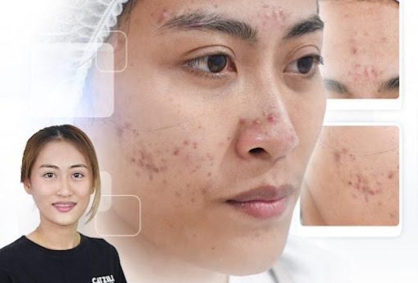 Acne & Scar Treatments
