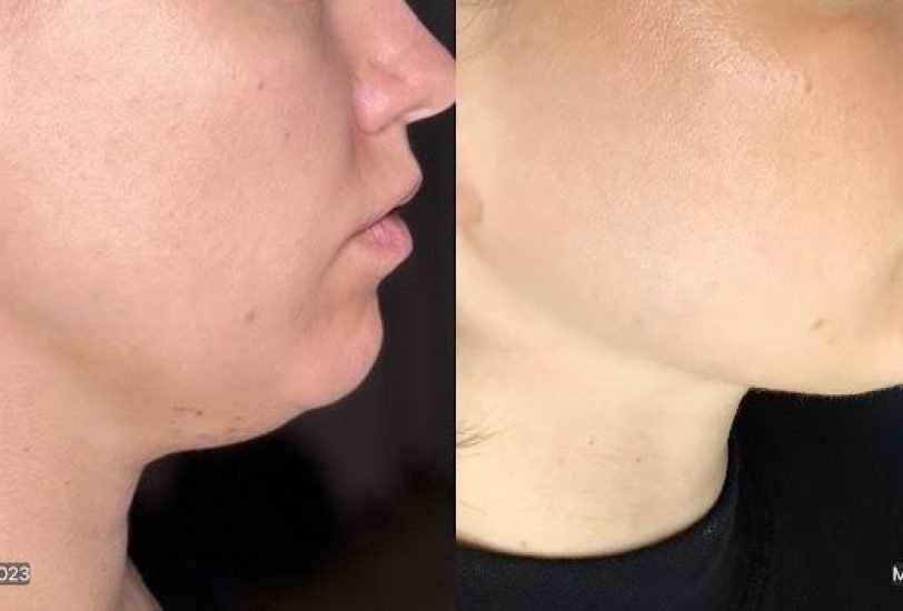 Double Chin & Jawline Contouring
