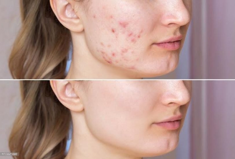 Skin Rejuvenation
