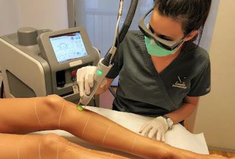 Laser Hair Removal