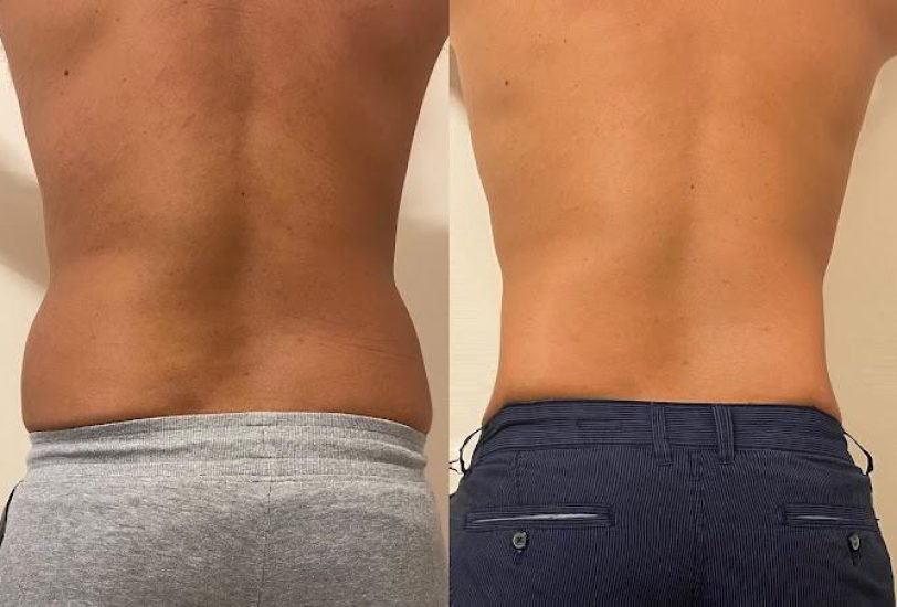 Fat Transfer