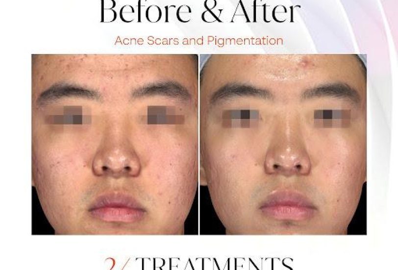 Facial Contouring & Lifting