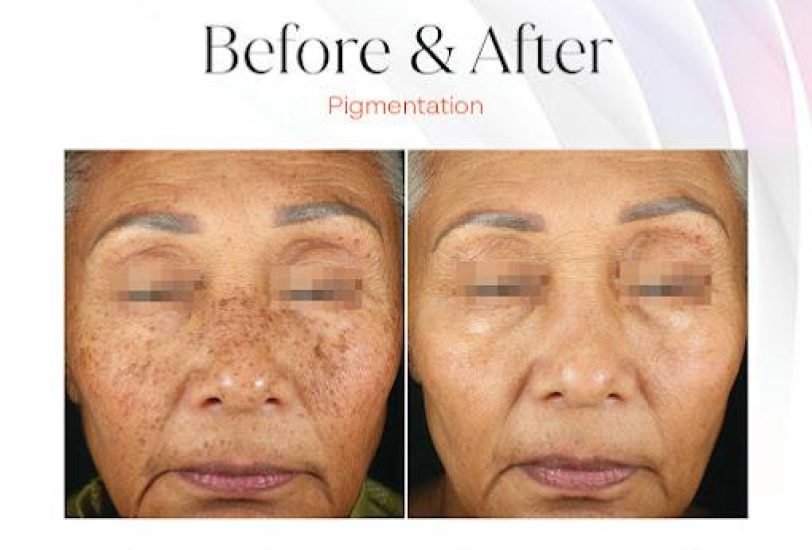 Anti-Aging Treatments